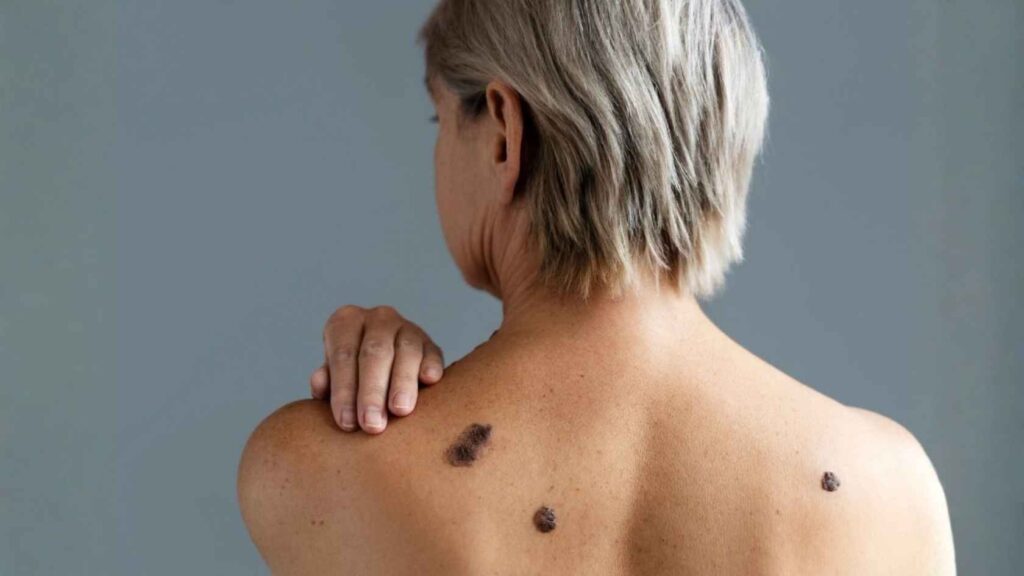 Skin Cancer Treatment