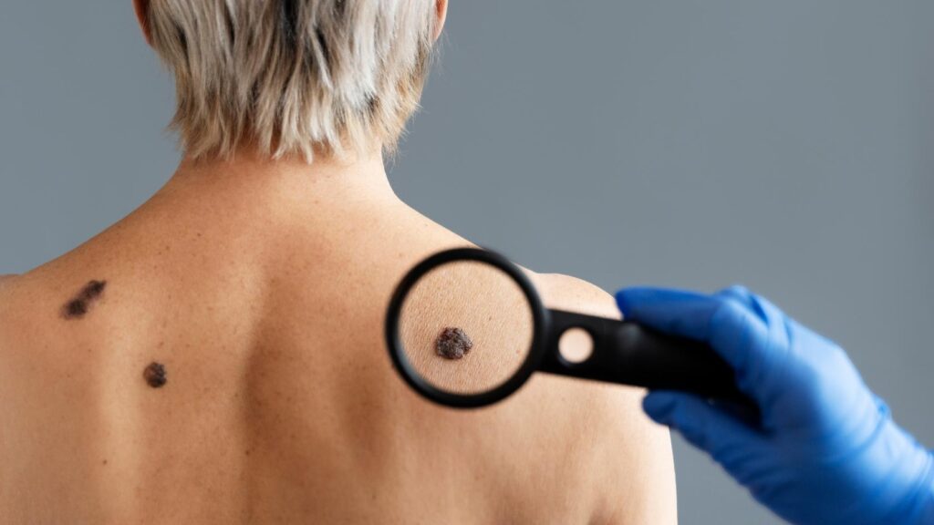 Dermatologist examining a suspicious mole on a patient’s back during skin cancer evaluation
