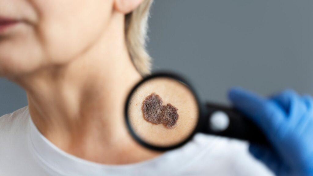 Close-up of suspicious neck mole examined with magnifying glass before skin cancer reconstruction planning