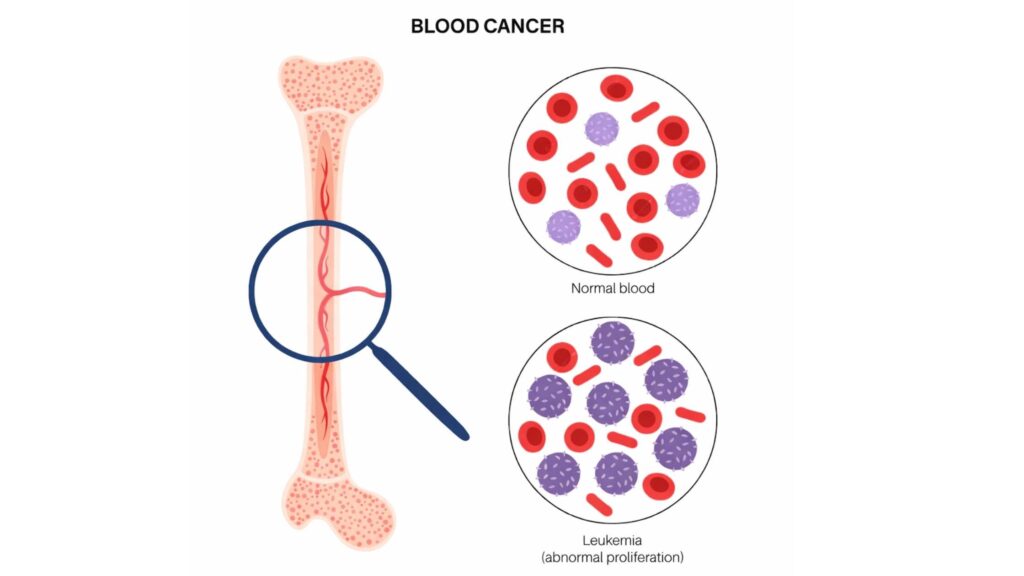 Blood Cancer Treatment in Thrissur diagram showing bone marrow and comparison of normal blood and leukemia cells